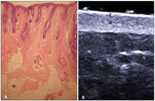 Corte histológico da pele humana ao lado de uma imagem de ultrassonografia de alta frequência (USAF). A imagem histológica mostra as camadas da epiderme (e), derme (d) e tecido subcutâneo (sc). A imagem ultrassonográfica, em corte transversal, evidencia as mesmas camadas, com destaque para os septos fibrosos no subcutâneo.