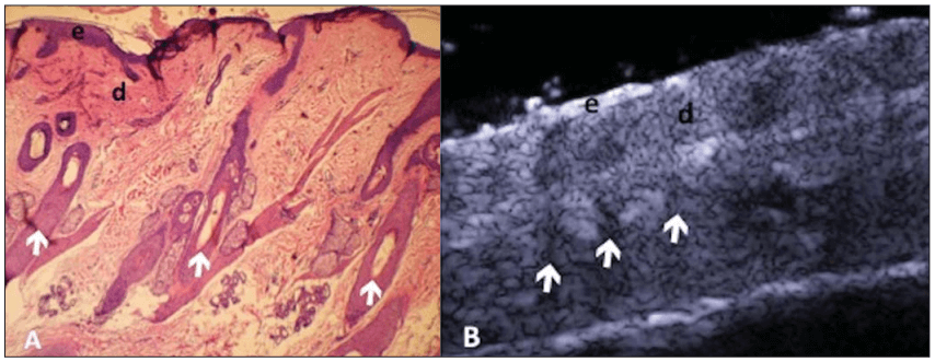 Comparação entre histologia e ultrassonografia de alta frequência (USAF) do couro cabeludo. À esquerda, corte histológico mostrando a epiderme (e), derme (d) e folículos pilosos (indicados por setas). À direita, imagem ultrassonográfica longitudinal evidenciando as mesmas estruturas: epiderme, derme e os folículos pilosos como áreas hipoecoicas alongadas.
