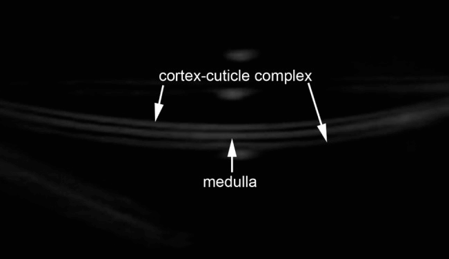 Imagem de ultrassom em corte longitudinal demonstrando um fio de cabelo saudável no couro cabeludo. Visualiza-se claramente a estrutura trilaminar hiperecóica correspondente às camadas de queratina: complexo córtex-cutícula e medula.